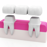 dental-crowns-and-bridges-1-1