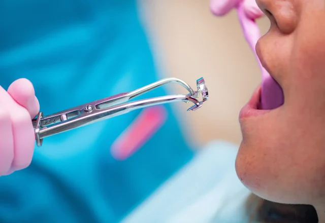 10-Tooth Extraction1 1