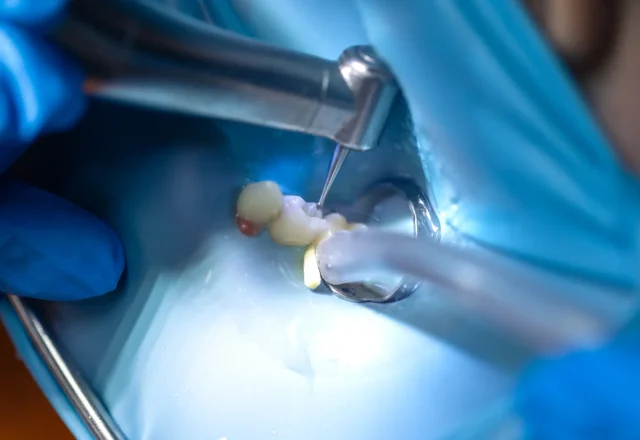 11-Root Canal Treatment1 1