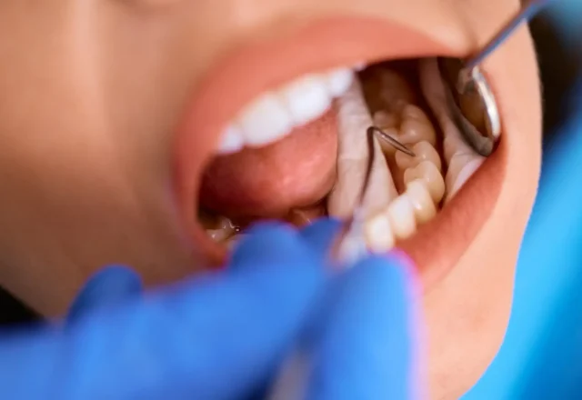 close-up-of-woman-during-teeth-check-up-at-dentist-2026-03-17-07-05-30-utc